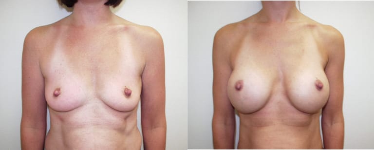 Before and after breast augmentation – front view showing enhanced breast volume and shape at Cary Plastic Surgery