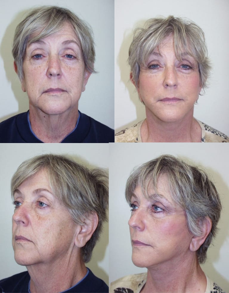 Before and after facelift surgery result – comparison showing improved facial contour and youthful appearance after rhytidectomy at Cary Plastic Surgery