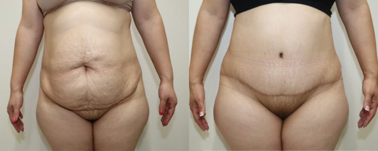 Pre-operative vs post-operative tummy tuck result – reduced excess skin and tightened abdominal profile after surgery